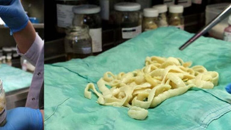 Tenya nedir ve neden oluşur? Tenya nasıl kaybedilir, tenya nasıl tedavi edilir?